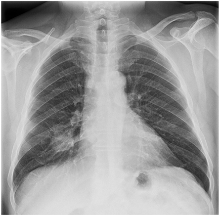 131125 Radiografia cancer